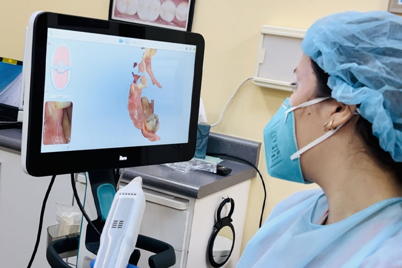 Itero Intraoral Scanner in San Jose