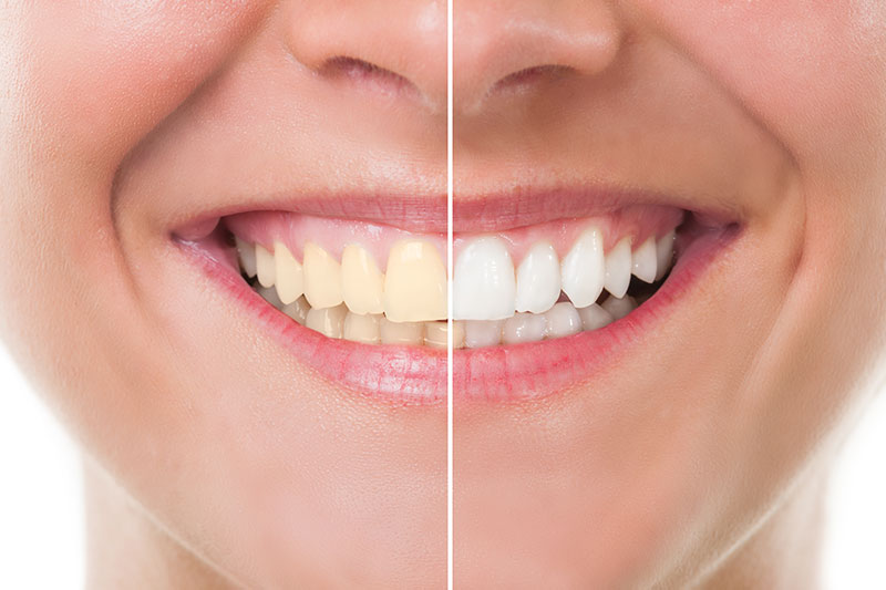 Opalescence® Teeth Whitening in San Jose
